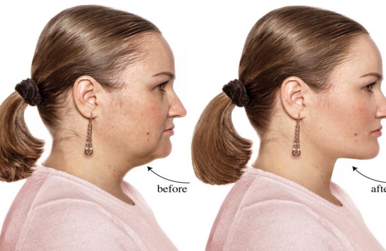 Why Accent XL Is Changing The Game For All Skin Types ?