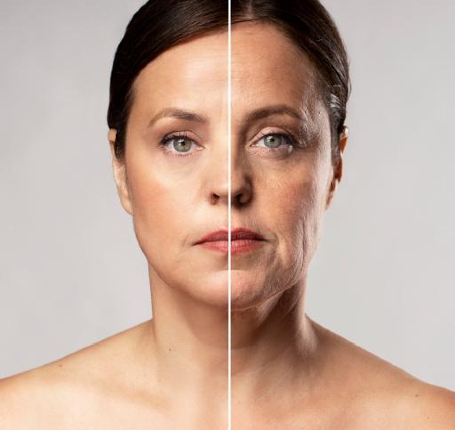Face & Neck Tightening with Accent XL – Smooth, Firm & Sculpt Naturally