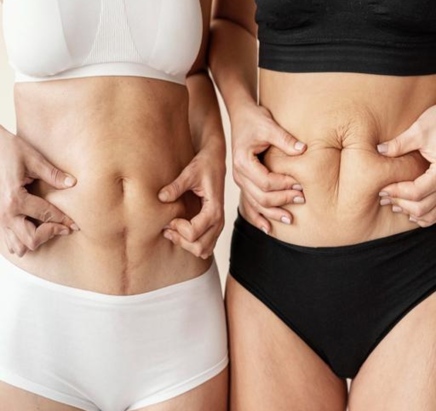 Thermage tightens and smooths the body by boosting collagen naturally, reducing sagging skin on arms, abdomen, thighs, and knees with no surgery or downtime.
